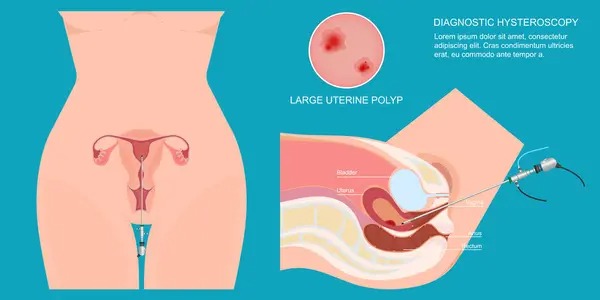 Workshop on Hysteroscopy