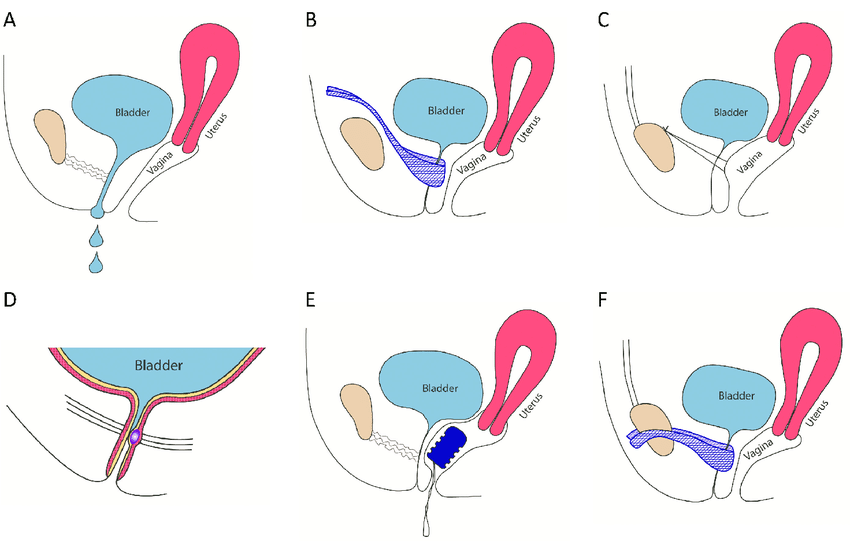 Workshop on Stress Incontinence Surgeries